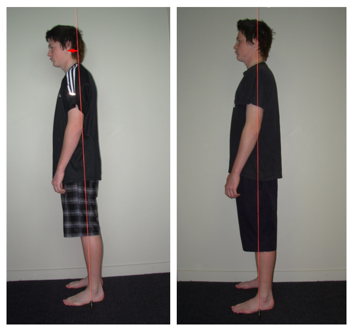 lower back pain posture auckalnd before and after back stretches auckland