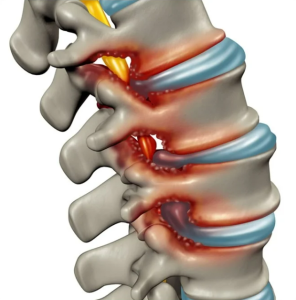 back pain specialist Auckland