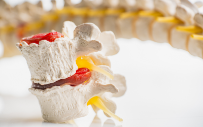 Therapy for Herniated Disc