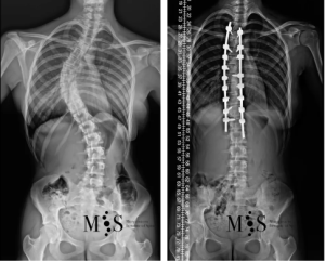 Scoliosis