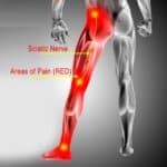 Sciatica and back pain