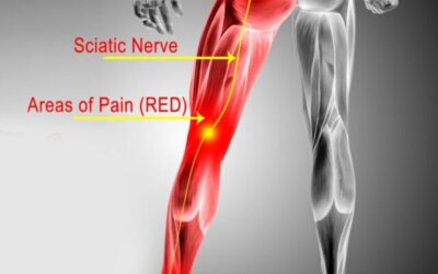 SCIATICA AND BACK PAIN