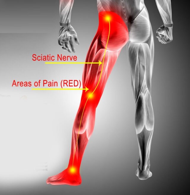 Can You Get Sciatica Pain In Your Groin