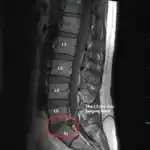 Disc bulge