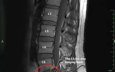 Why your MRI might not explain your lower back pain