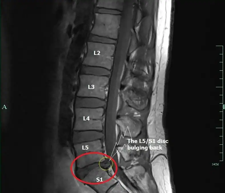 Disc bulge