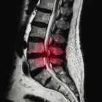 Sciatica Treatment, Disc Bulge
