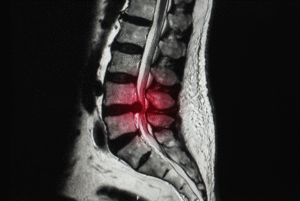 Lower Back Pain