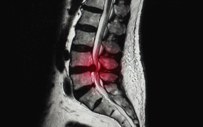 Disc Bulge and Slipped Disc: What to Do Next