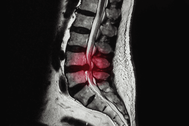 Disc Bulge